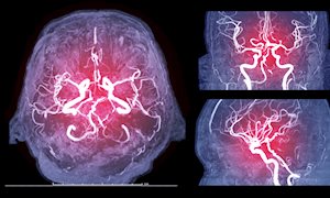 Microinfarct in de hersenen alleen zichtbaar in acute fase
